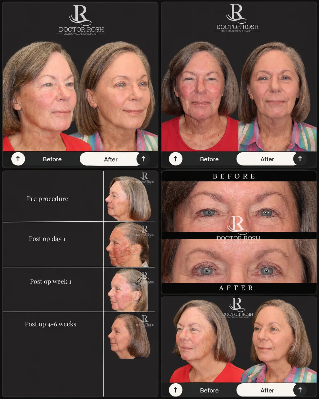 CO2/Erbium laser skin resurfacing before and after - McDavid full face rejuvenation