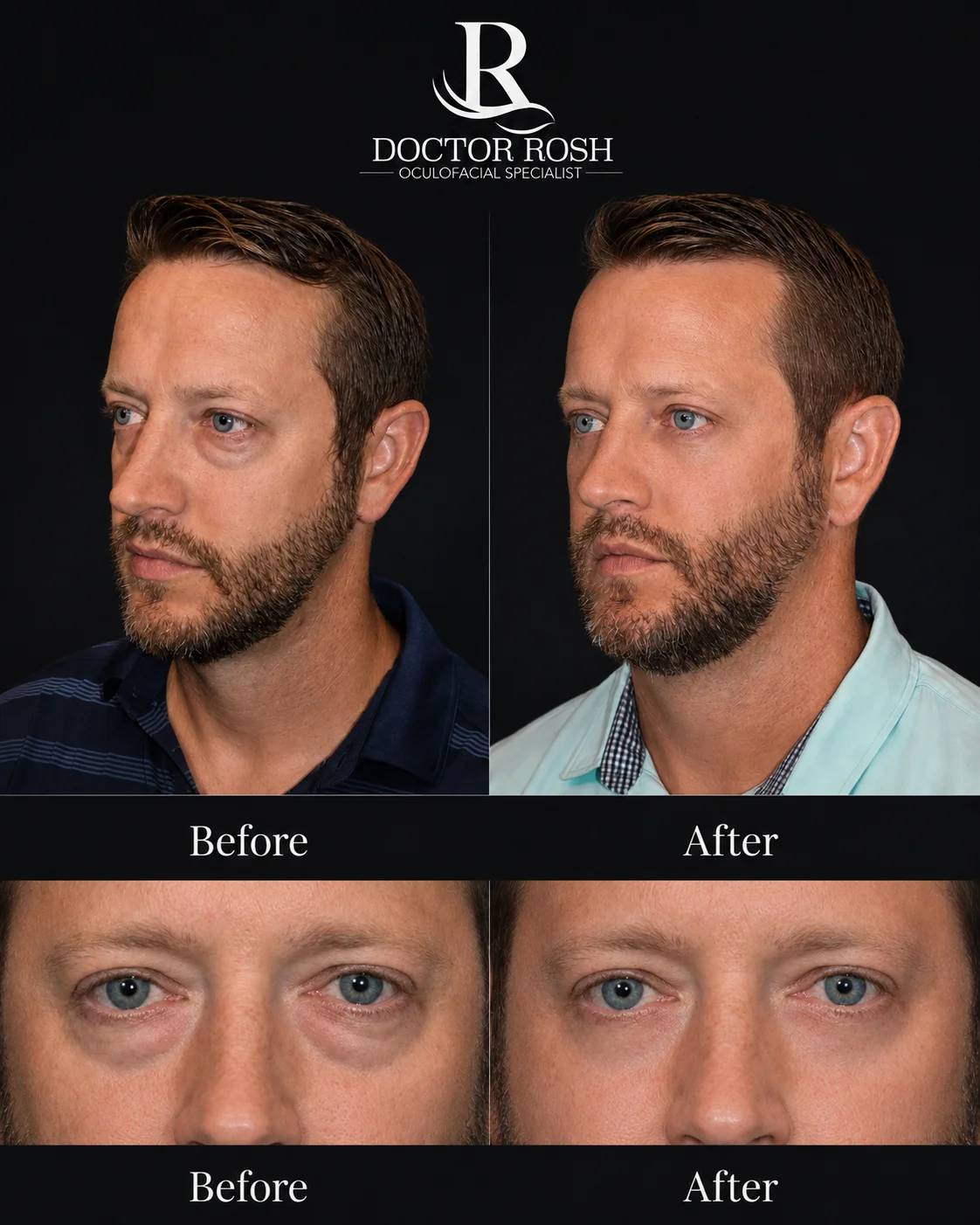 Lower blepharoplasty before and after - Farra front and eye detail