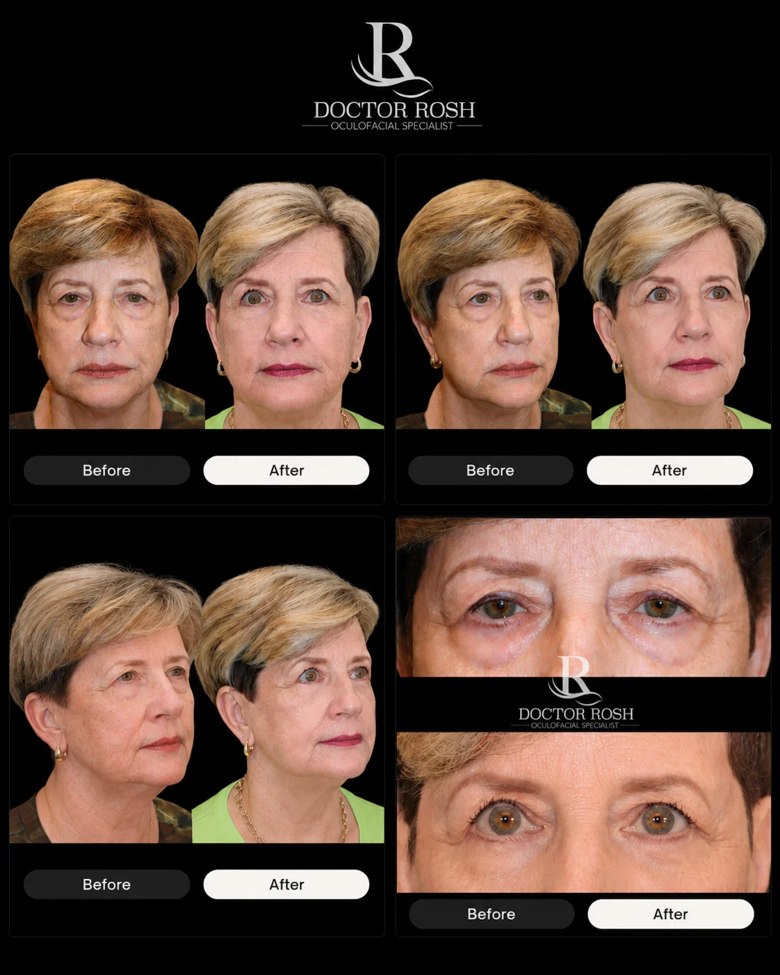 Lower blepharoplasty before and after - Noriega multi-view grid
