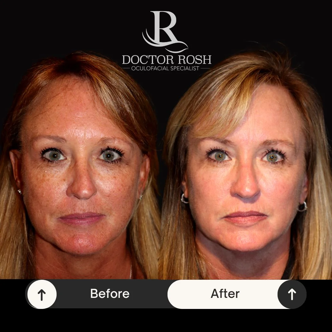 BBL/MOXI before and after - Patient 2
