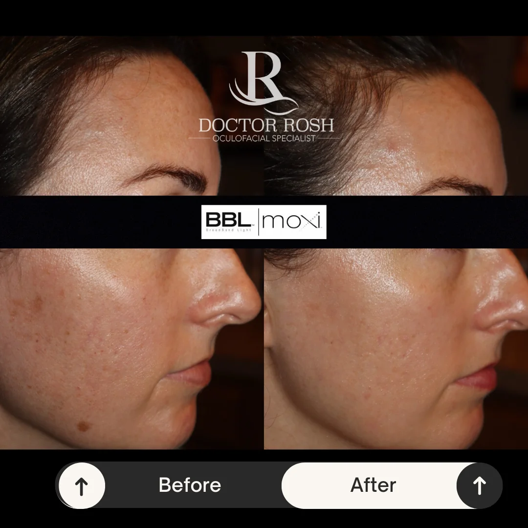 BBL/MOXI before and after - Patient 5