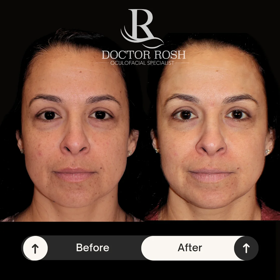 BBL/MOXI before and after - Patient 6