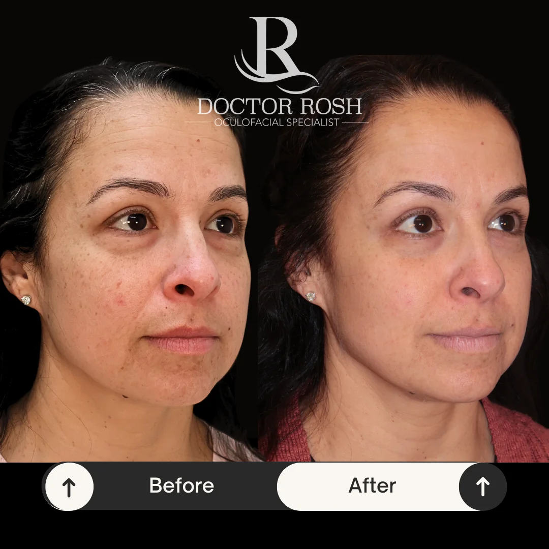 BBL/MOXI before and after - Patient 8