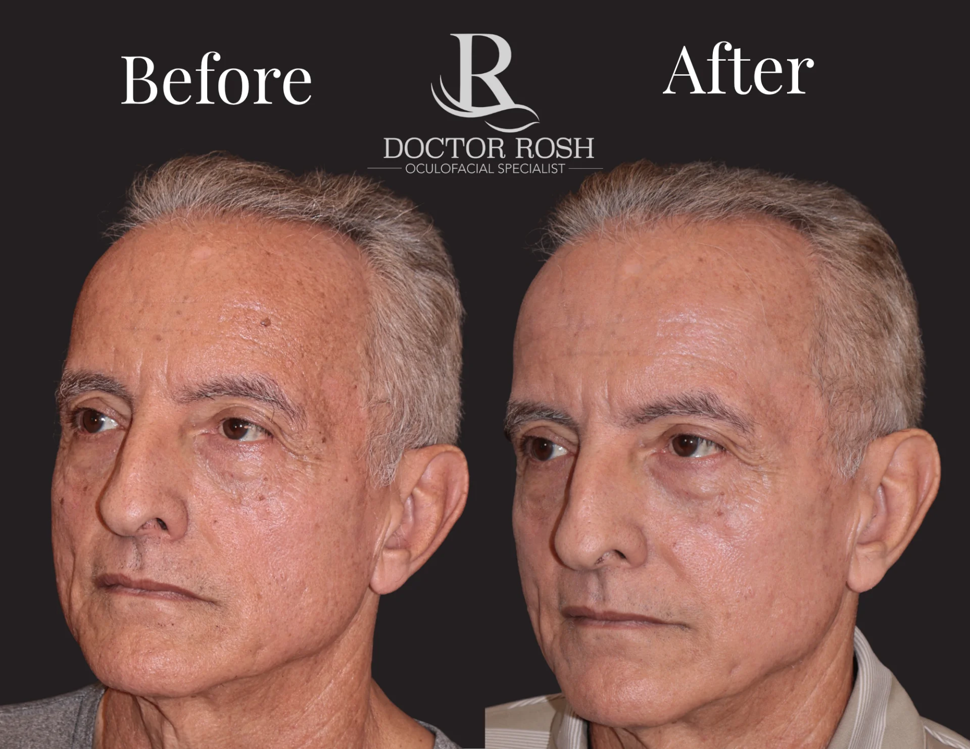 BBL/MOXI before and after - Adalberto three-quarter view