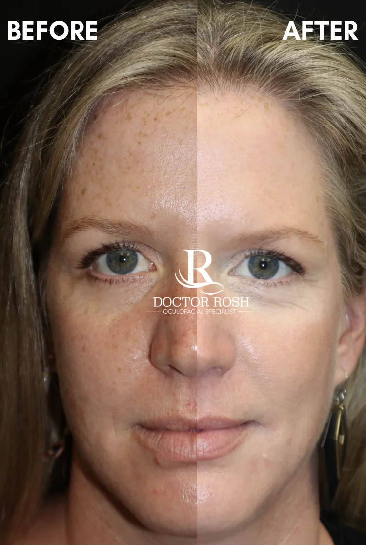 BBL/MOXI before and after - split face view