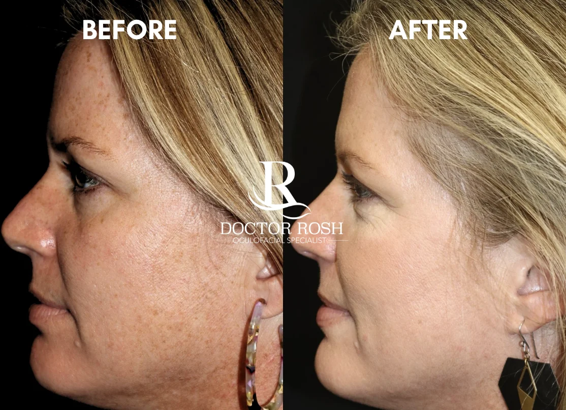 BBL/MOXI before and after - side profile
