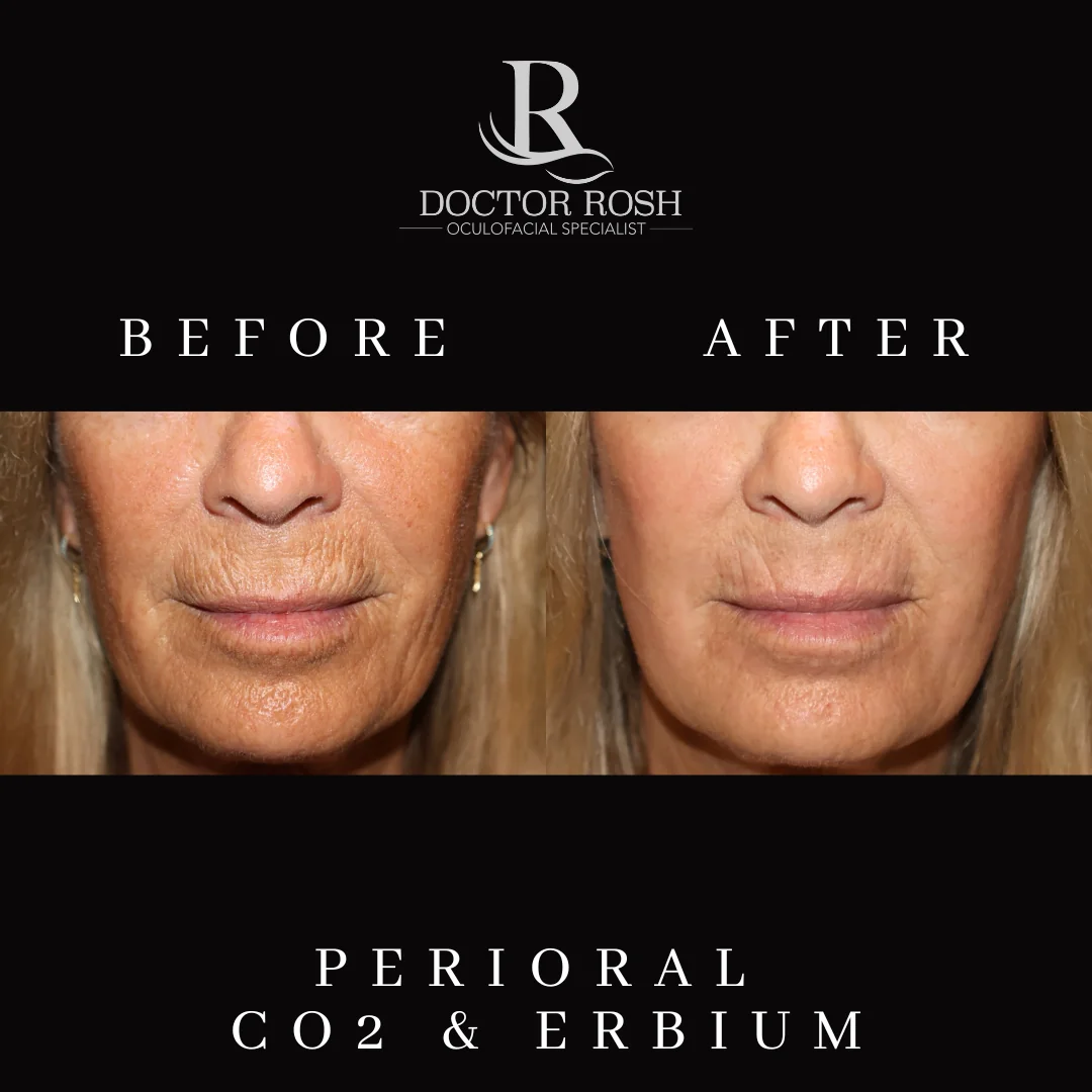 CO2/Erbium perioral before and after - Patient 1