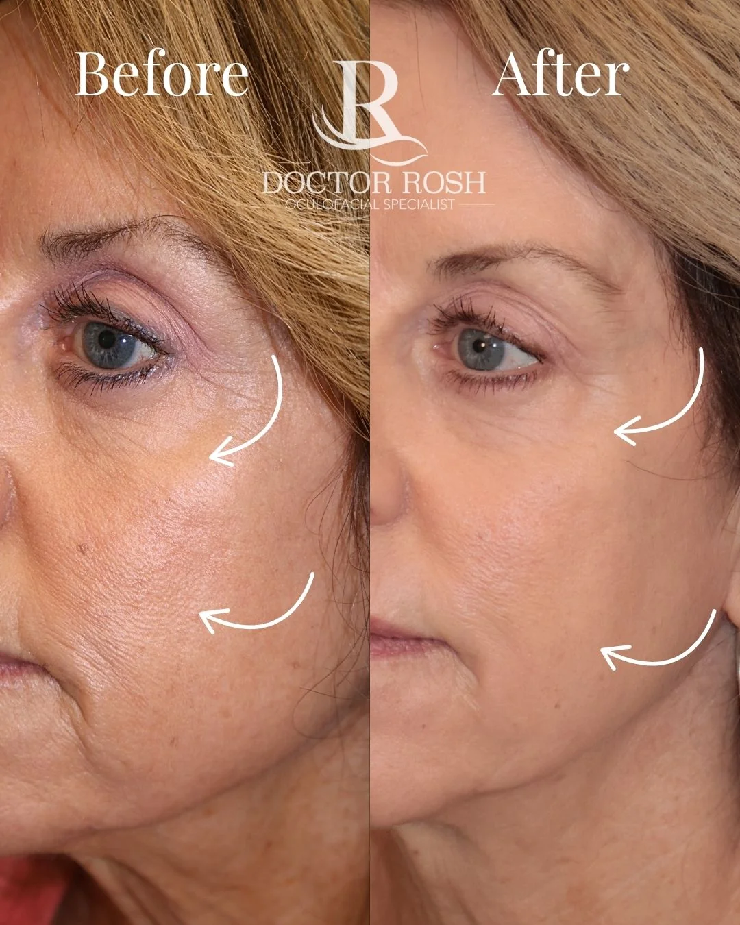 CO2/Erbium laser skin resurfacing before and after - cheek and lower eyelid texture