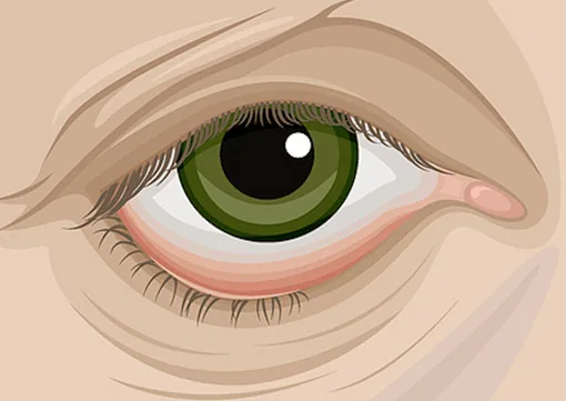 Ectropion & Entropion