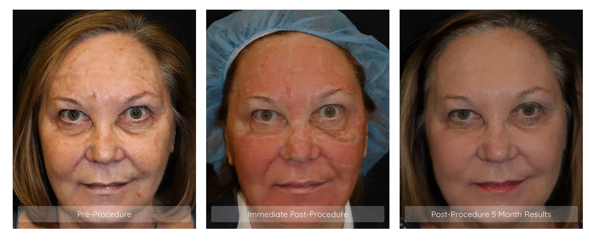 CO2 laser resurfacing pre and post procedure