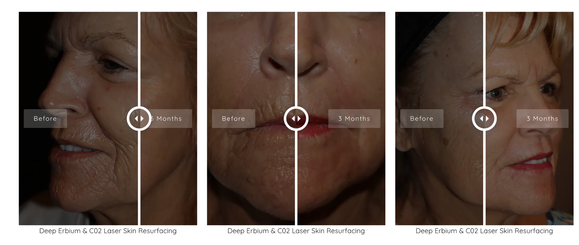 Deep Erbium & CO2 laser skin resurfacing