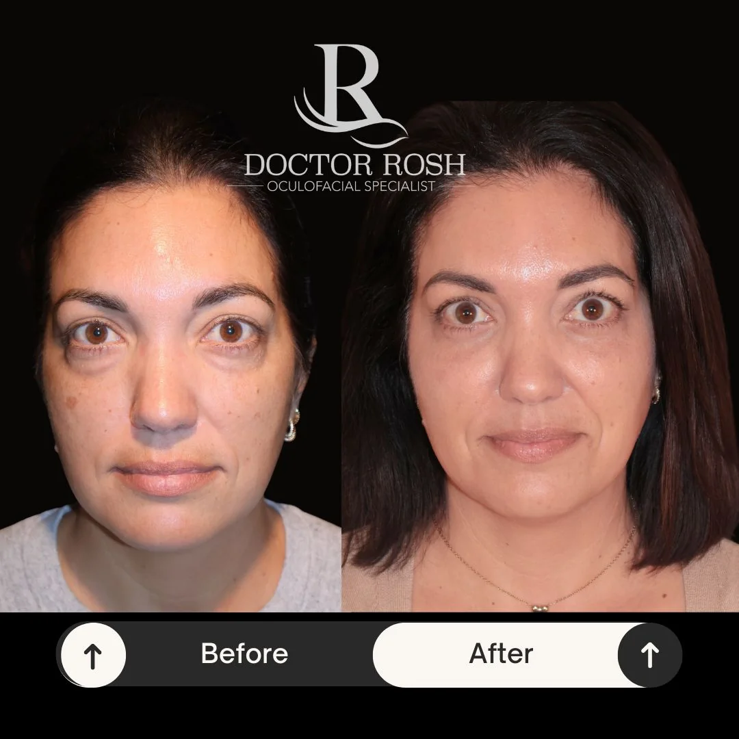 Lower blepharoplasty before and after - Bishop