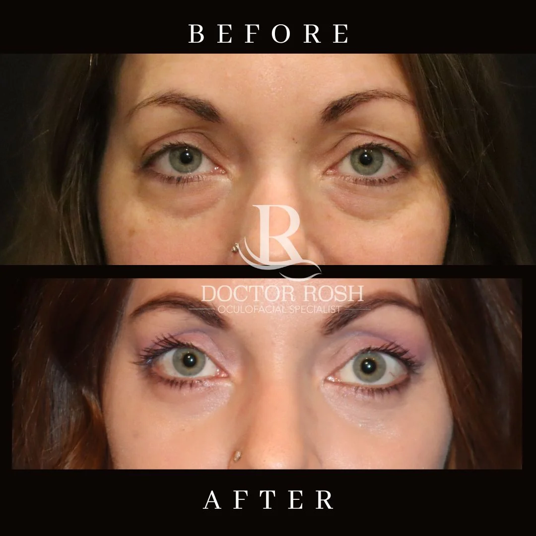 Lower blepharoplasty before and after - Britta eye detail