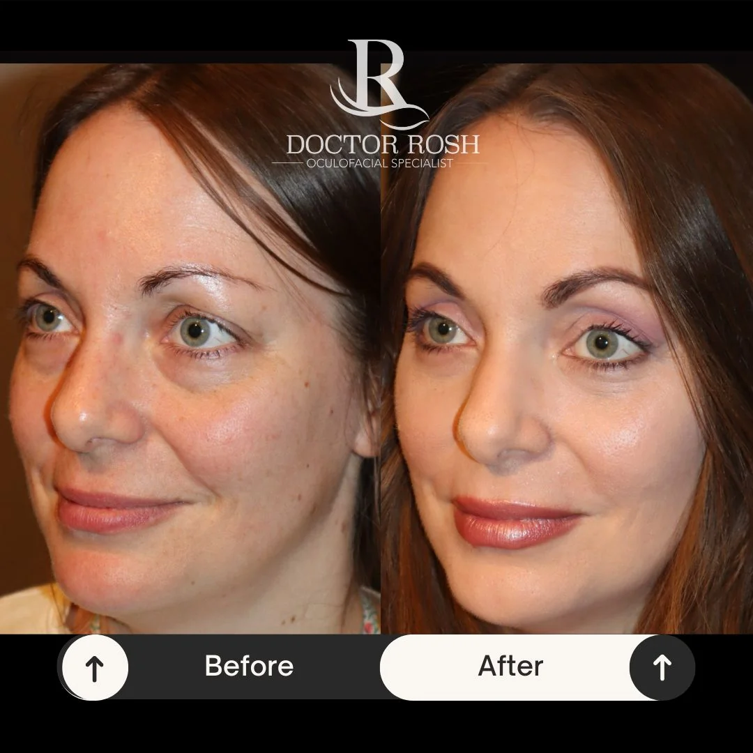 Lower blepharoplasty before and after - Britta full face