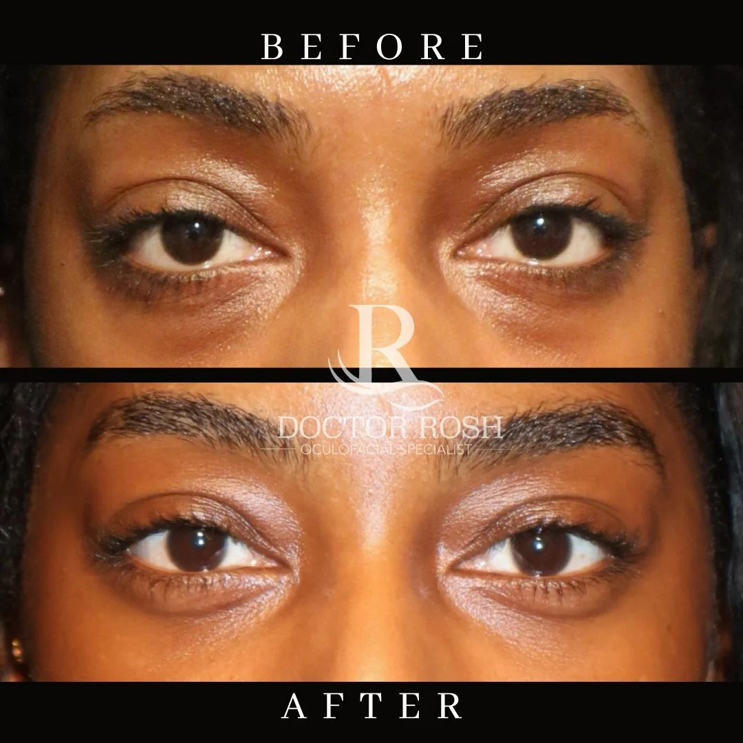 Lower blepharoplasty before and after - Corso eye detail