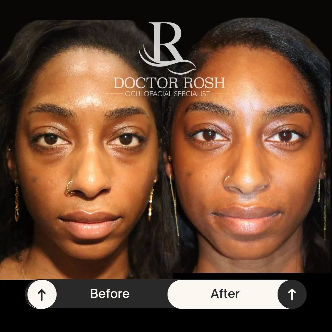 Lower blepharoplasty before and after - Corso full face