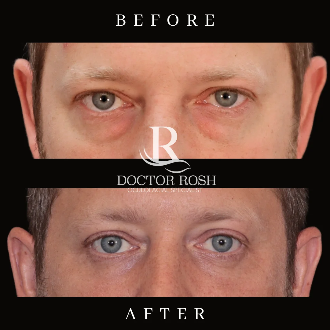Lower blepharoplasty before and after - Farra eye detail