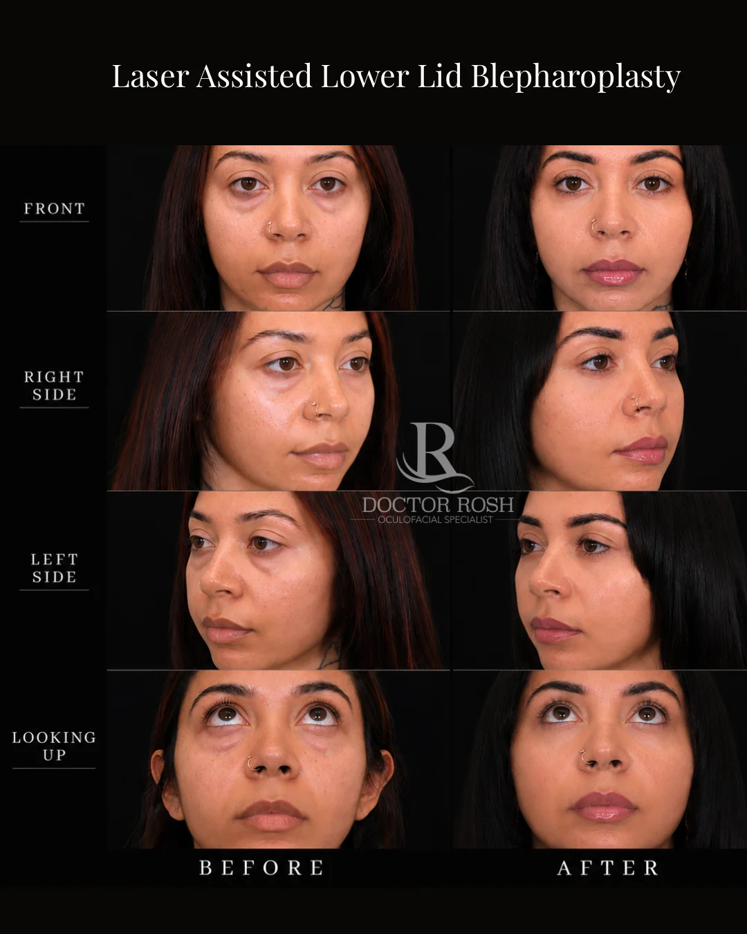 Laser assisted lower lid blepharoplasty before and after - multiple views