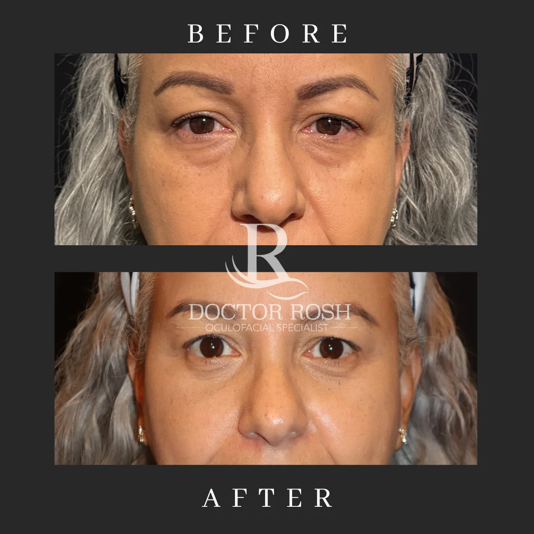 Lower blepharoplasty before and after - front view