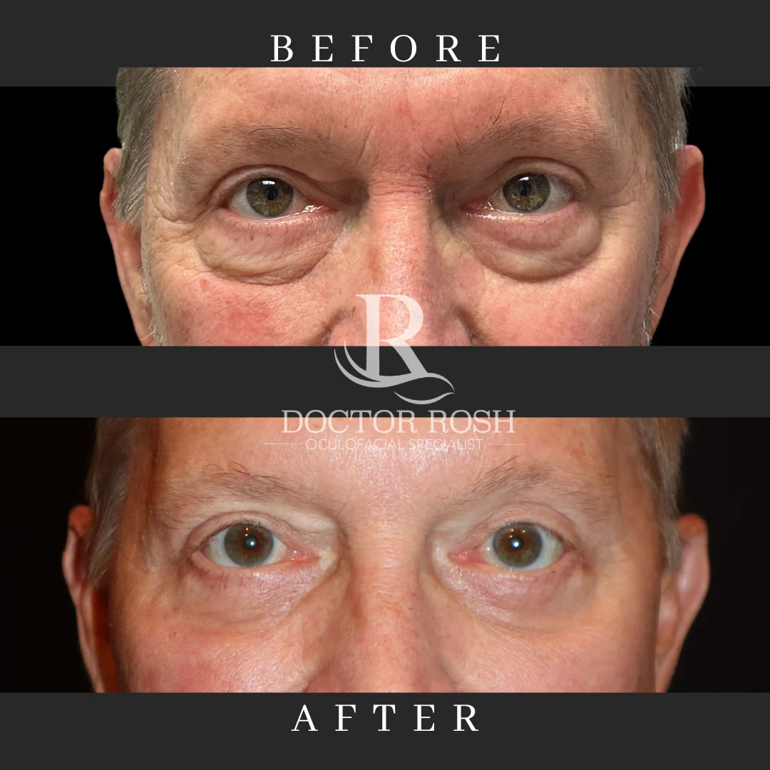 Lower blepharoplasty before and after - eye detail