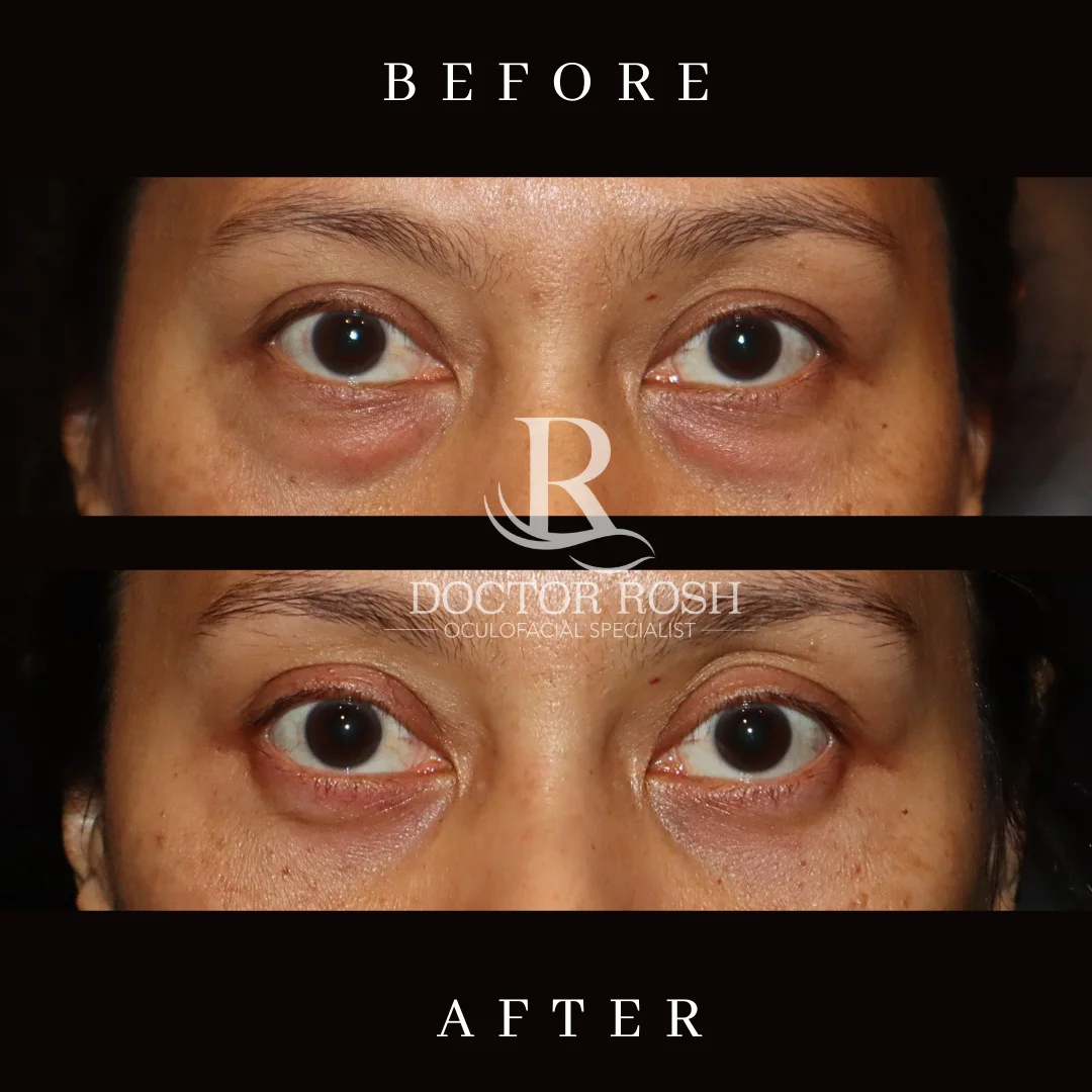 Lower blepharoplasty before and after - Pujiastuti eye detail