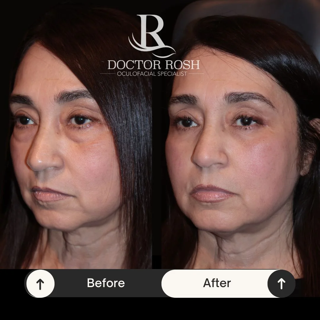 Lower blepharoplasty before and after - Ramos side view