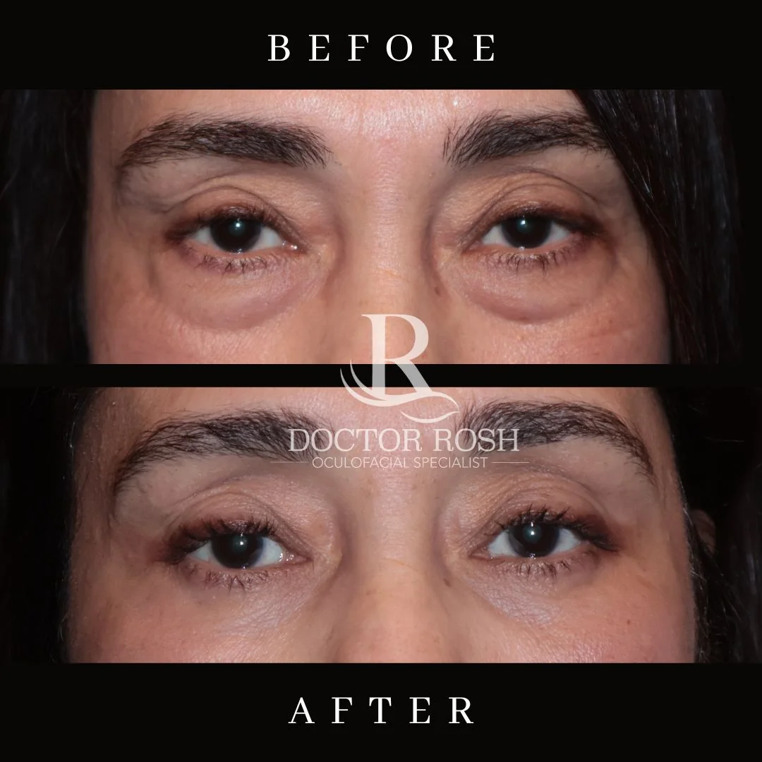 Lower blepharoplasty before and after - Ramos eye detail