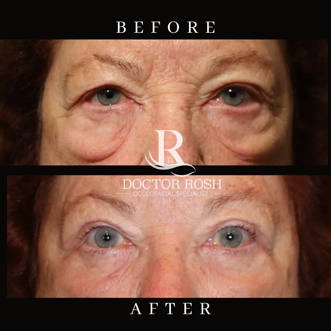 Lower blepharoplasty before and after - Whitley eye detail