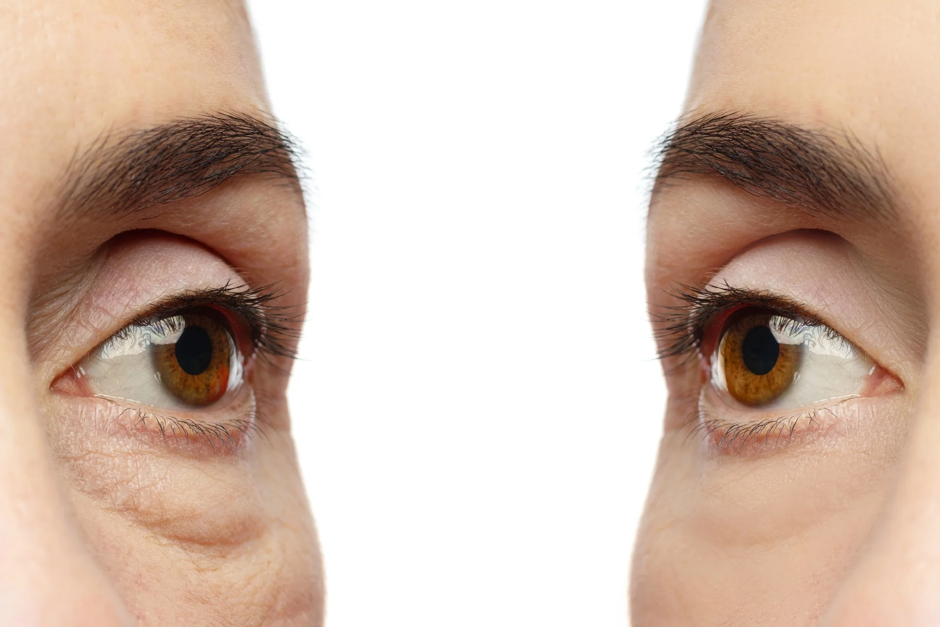 Lower Lid Blepharoplasty