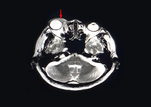 Orbital Tumors