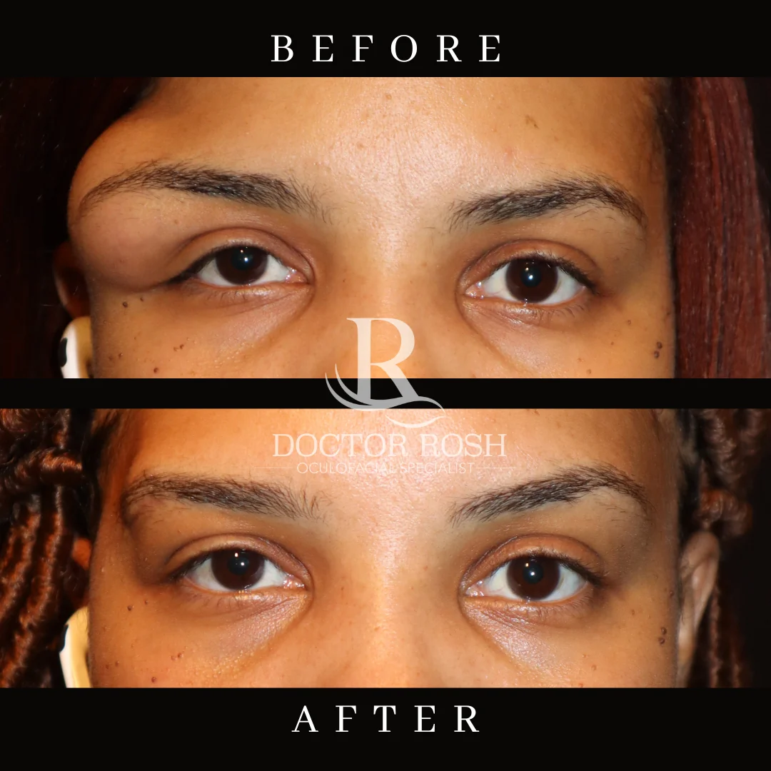 Orbitonomy before and after - Patient 1 eye detail