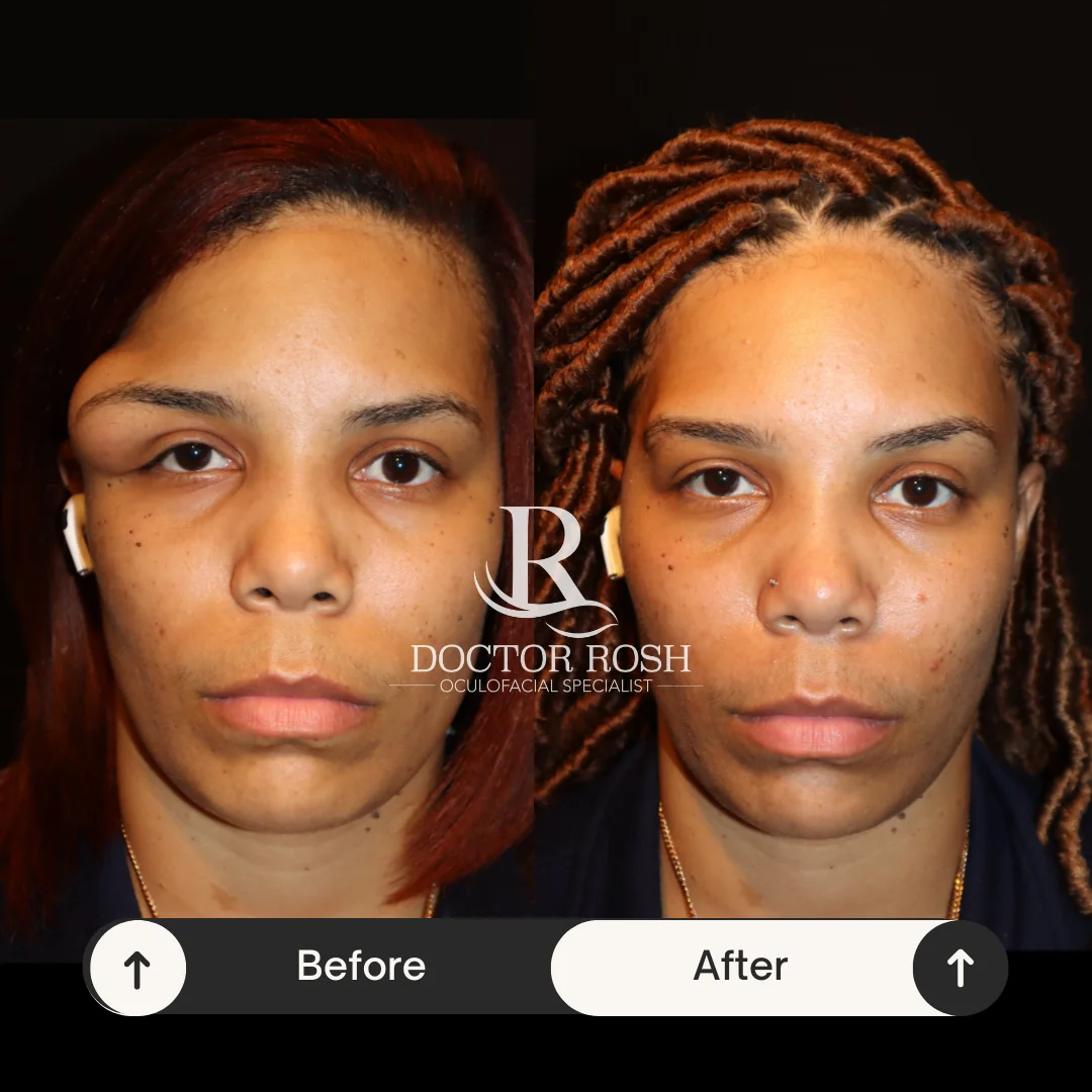 Orbitonomy before and after - Patient 1 full face