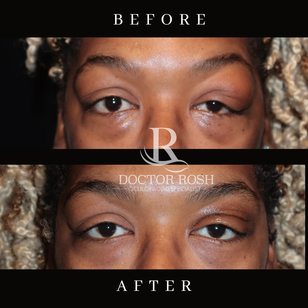Orbitonomy before and after - Patient 2 eye detail