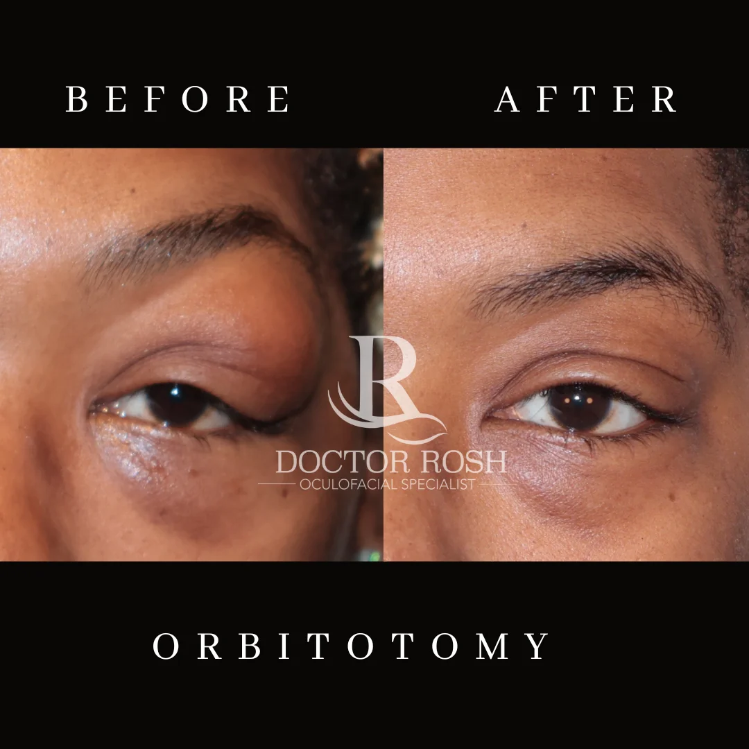 Orbitotomy before and after - Patient 3 eye detail