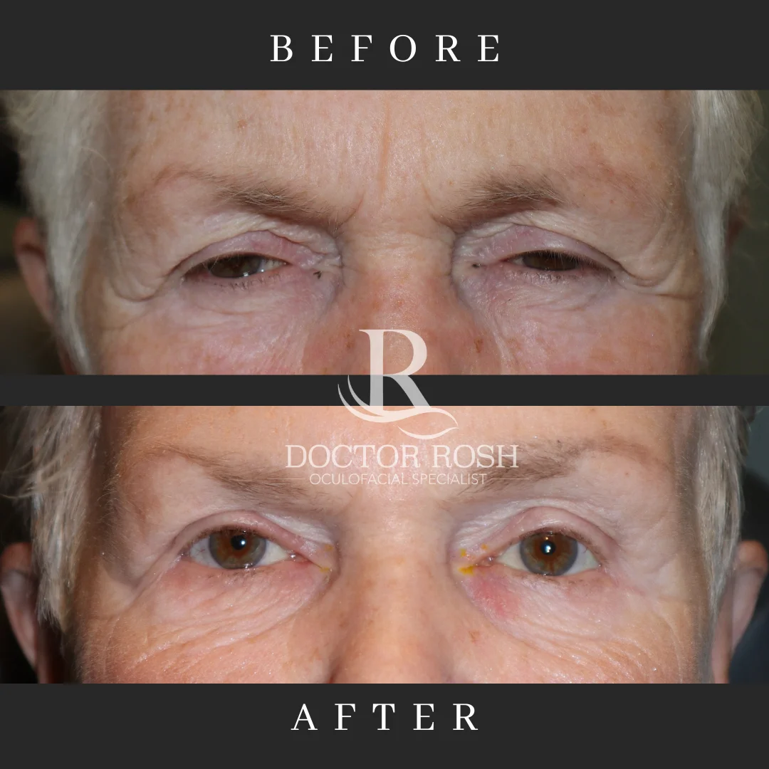 Ptosis repair before and after - patient 4