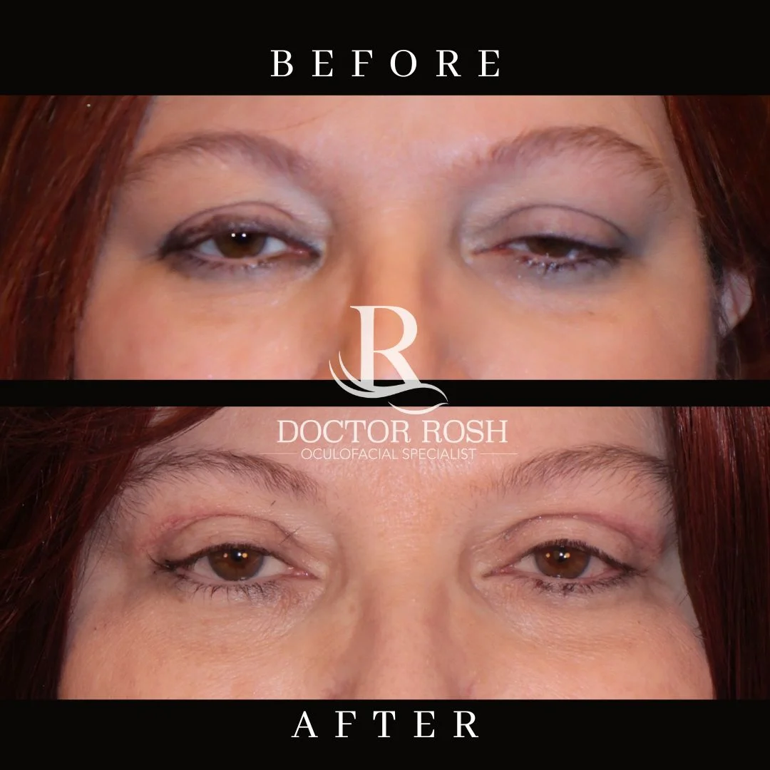 Ptosis repair before and after - Boemmel