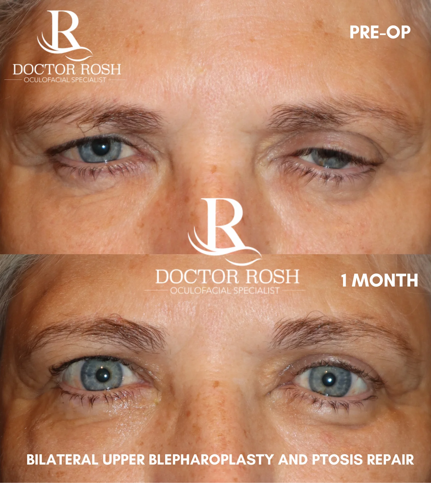 Ptosis repair before and after - Crill