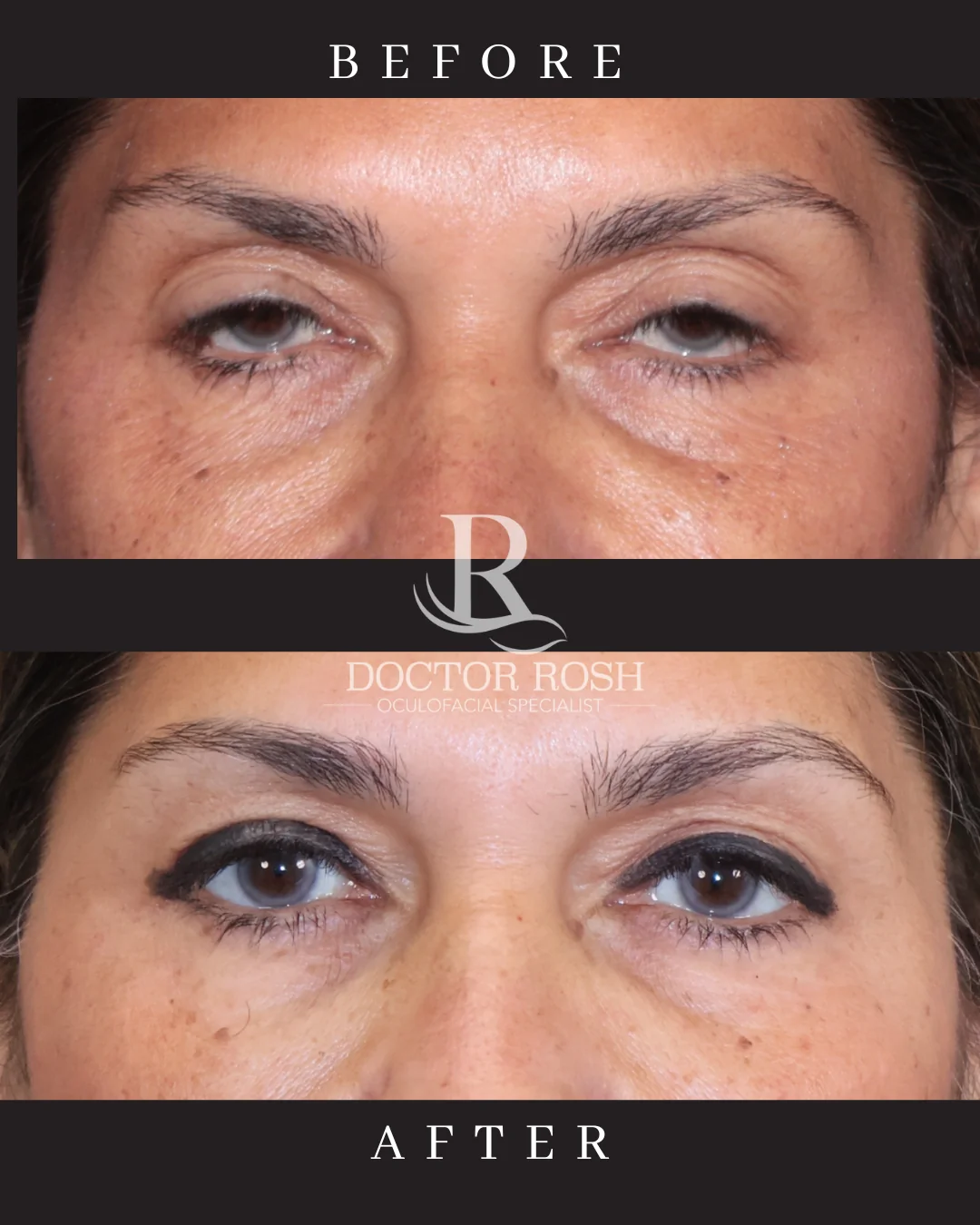 Ptosis repair before and after - Grindol