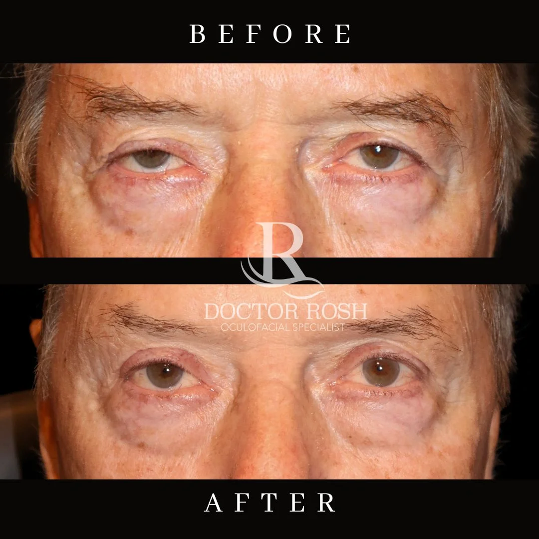 Ptosis repair before and after - Hartwig