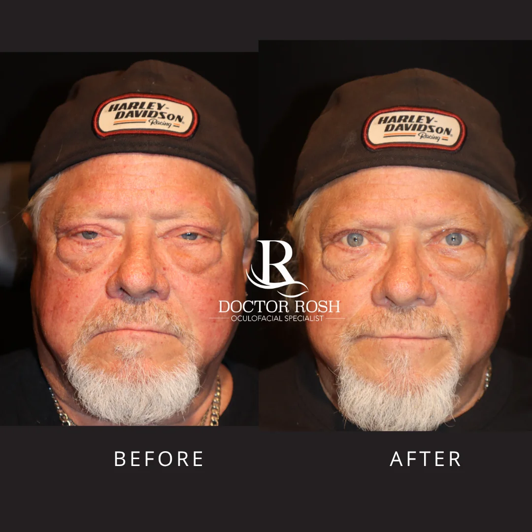 Ptosis repair before and after - 1 week post-op
