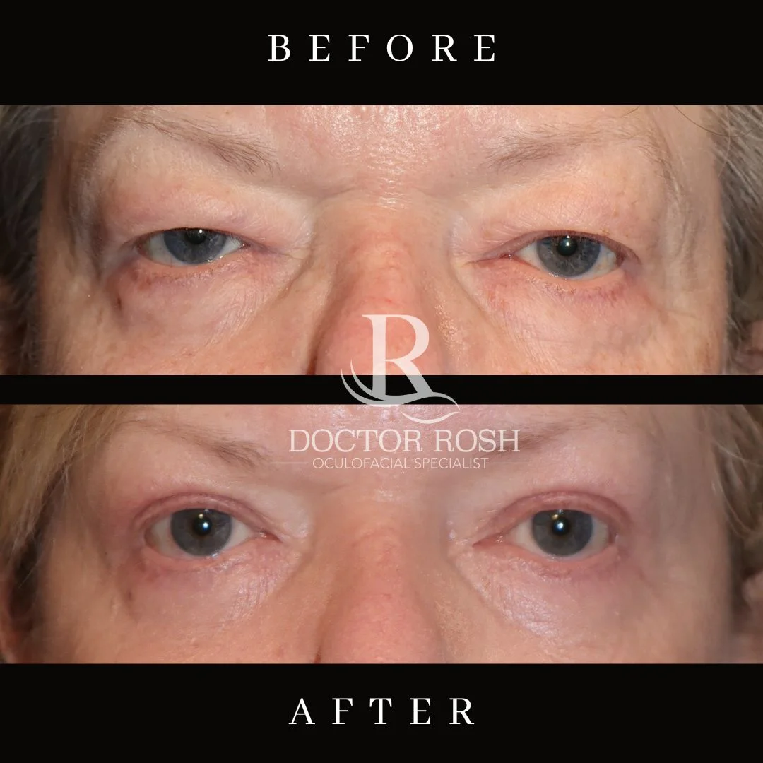 Ptosis repair before and after - Mullins