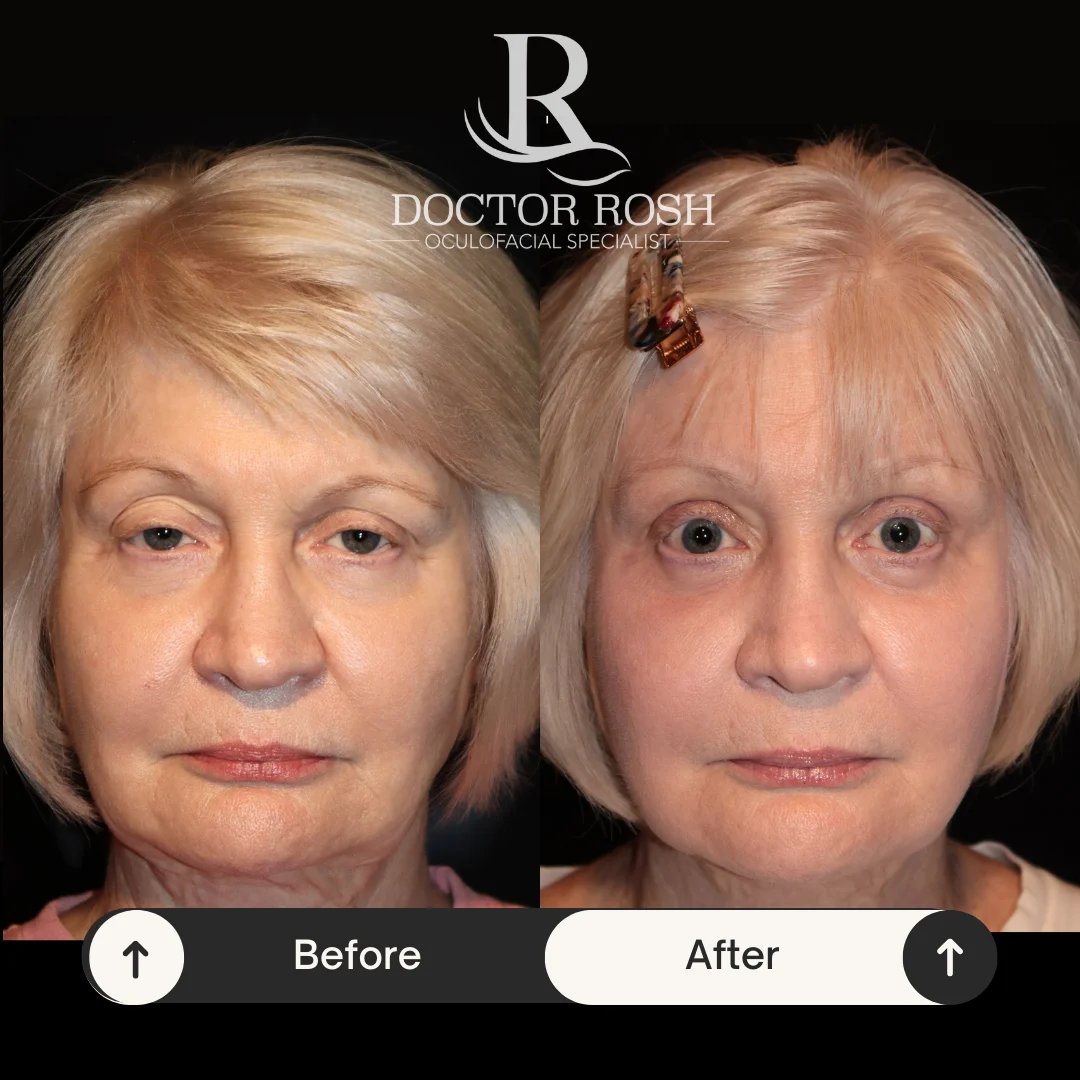 Ptosis repair before and after - front view full face