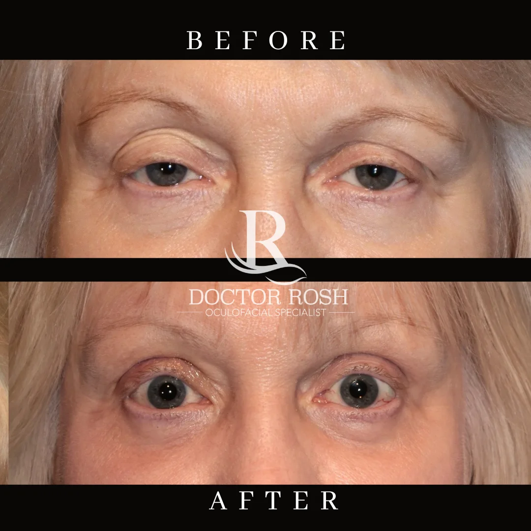 Ptosis repair before and after - eye detail