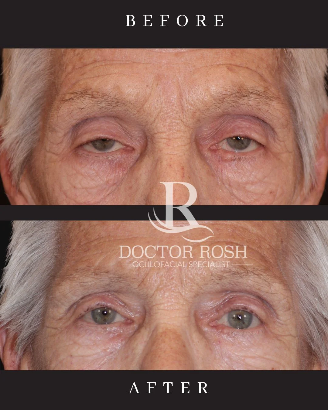 Ptosis repair before and after - bilateral upper eyelid elevation