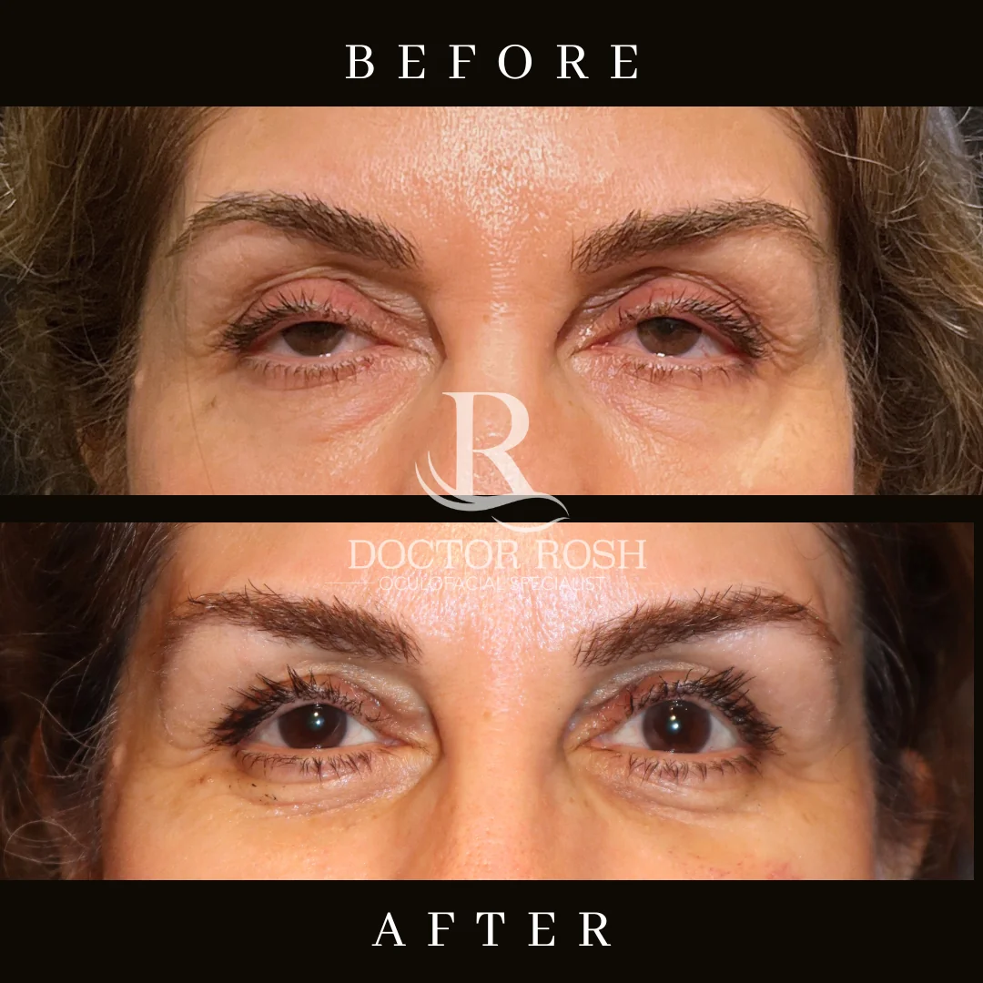 Ptosis repair before and after - Patient 1