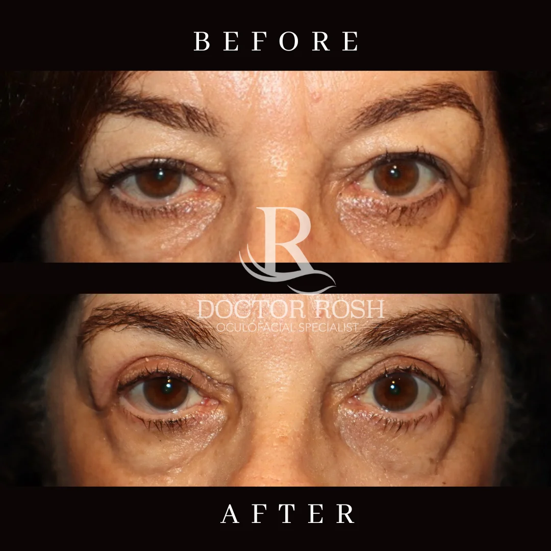 Ptosis repair before and after - DeSouza