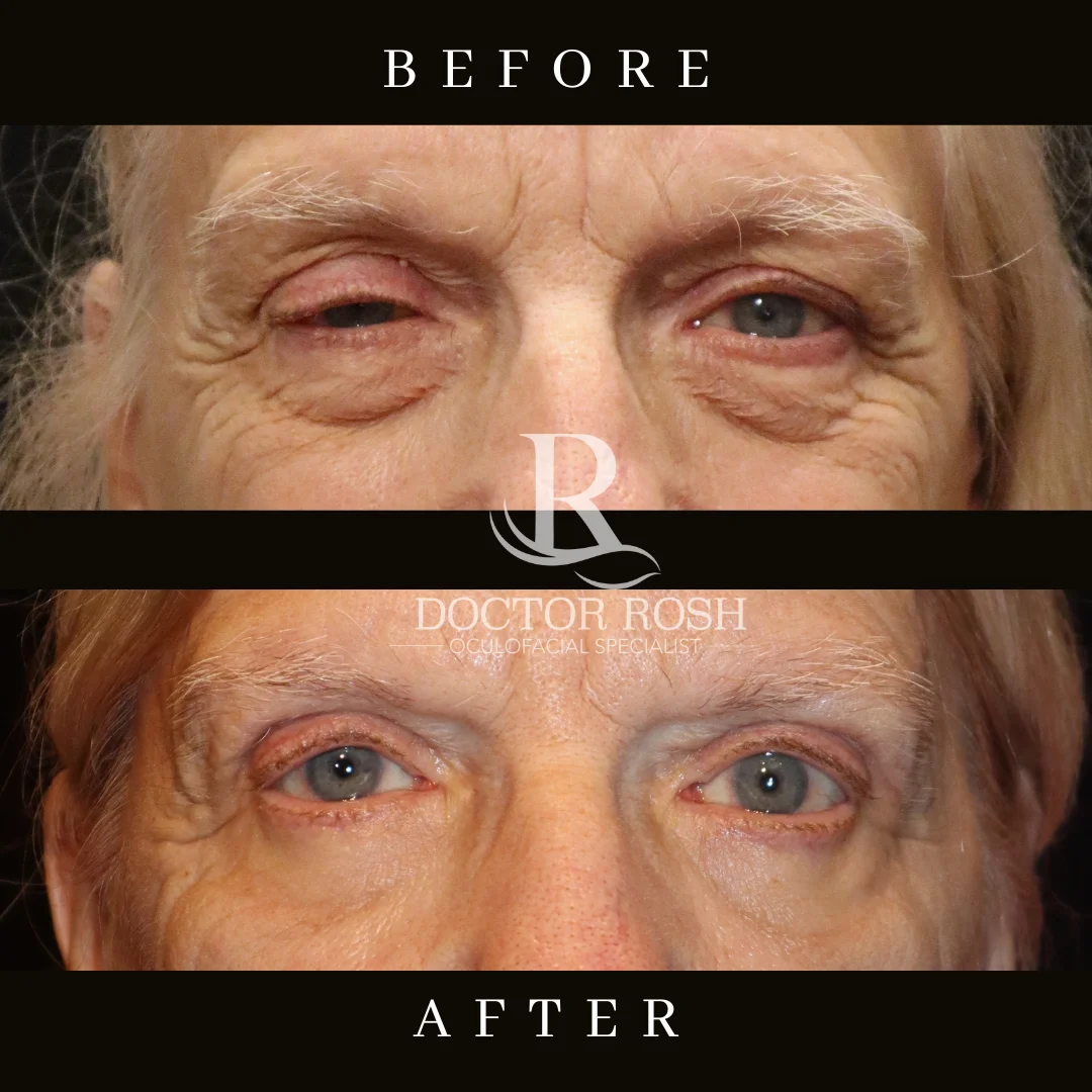 Ptosis repair before and after - Snyder