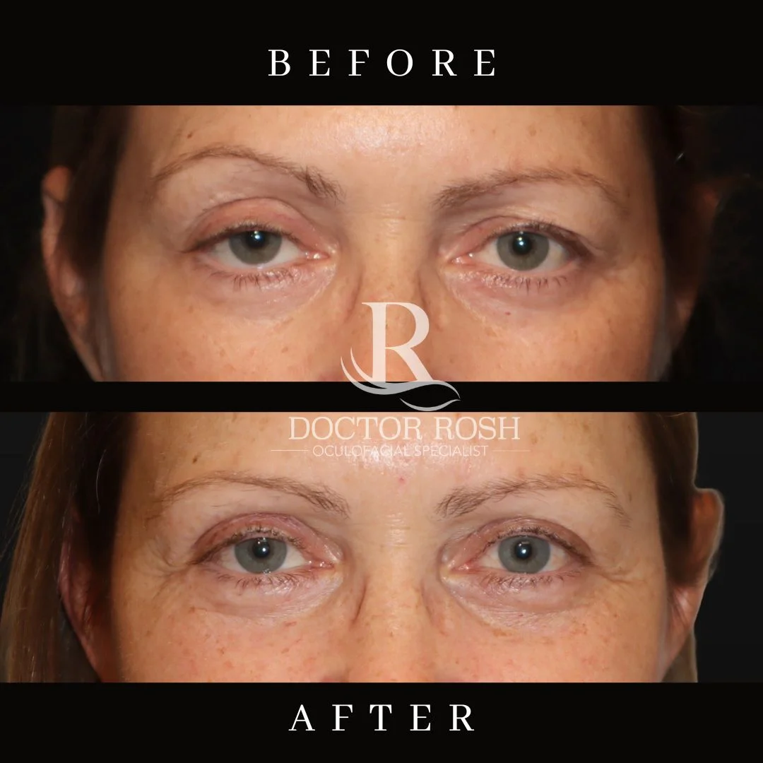 Ptosis repair before and after - Stein second case