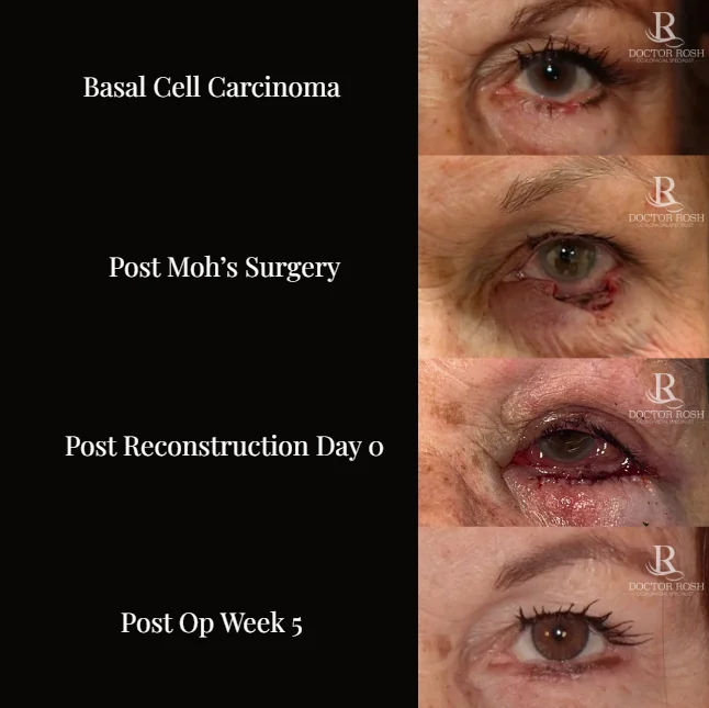 Basal Cell Carcinoma reconstruction - Post Moh's Surgery to Post Op Week 5