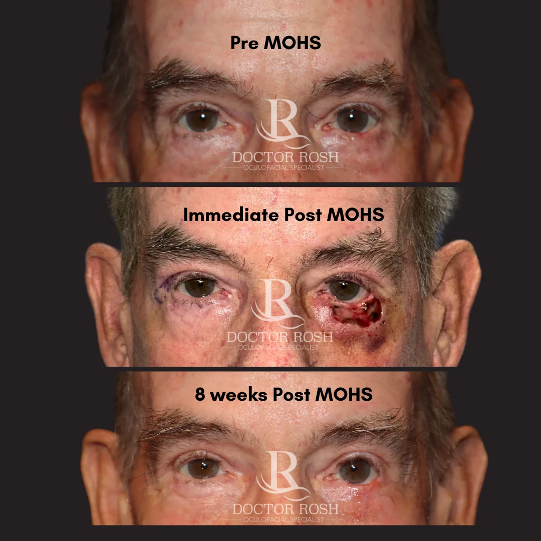 MOHS reconstruction before and after - Pre MOHS, Immediate Post MOHS, and 8 weeks Post MOHS